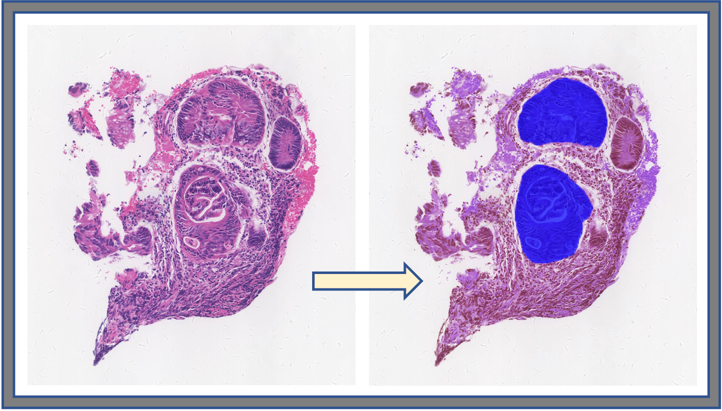 Cancer diagnosis - Image segmentation
